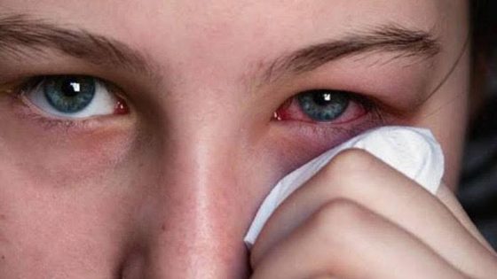 طبيب أردني يحذر من فيروس صيفي شديد العدوى يهاجم الحلق والعينين .. وهذه أبرز أعراضه